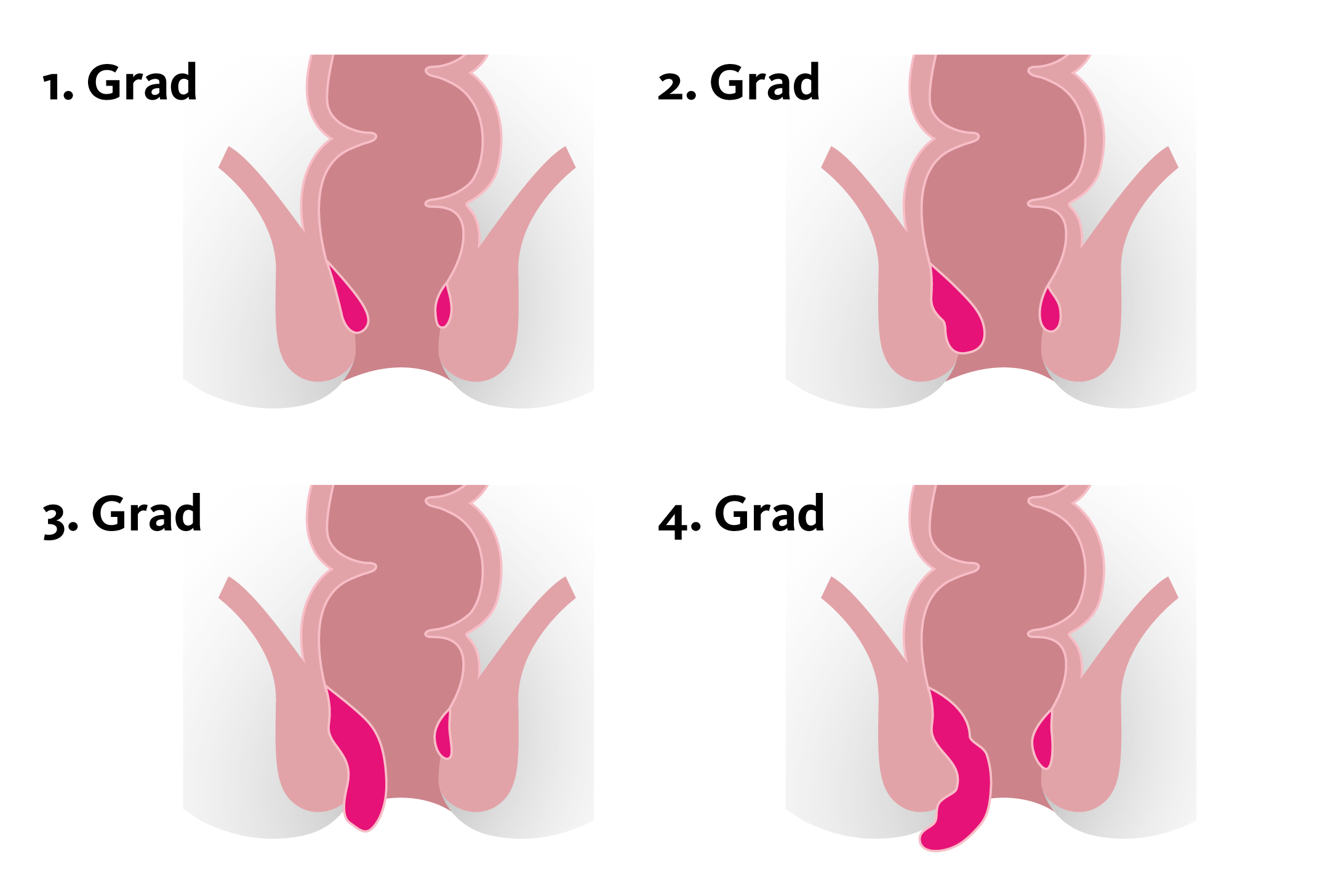 Illustration von Hämorrhoiden ersten bis vierten Grades