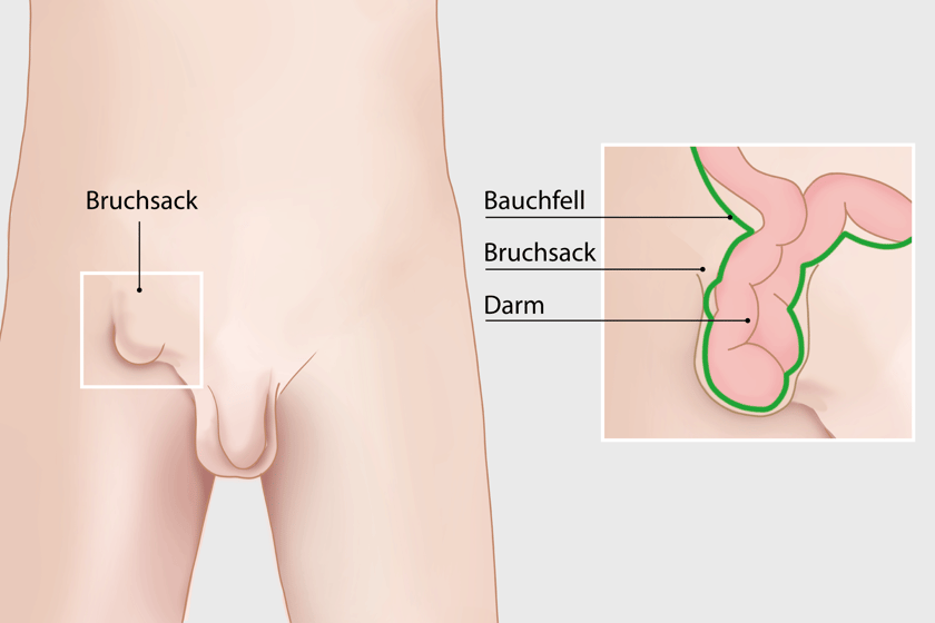 Leistenbruch beim Mann: Illustration plus Detailansicht